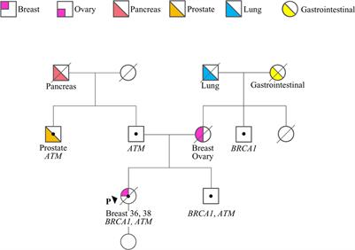 A novel BRCA1 splicing variant detected in an early onset triple-negative breast cancer patient additionally carrying a pathogenic variant in ATM: A case report